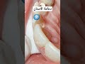 دعامة الاسنان دكتور عبدالله سلطان الهنداوي دعامة الاسنان دكتور عبدالله سلطان الهنداوي