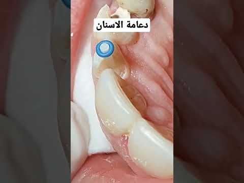 دعامة الاسنان دكتور عبدالله سلطان الهنداوي