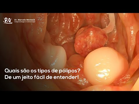 Vídeo: Pólipos: Tipos, Tratamentos E Biópsia