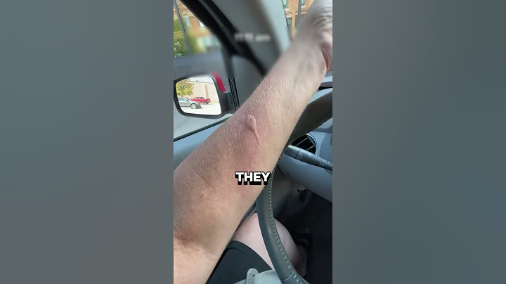 BEE STING 😱