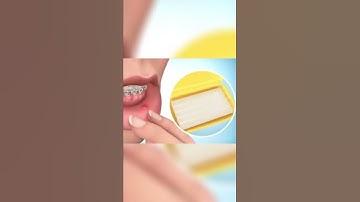 Cách sử dụng sáp nha khoa cho người niềng răng | #short