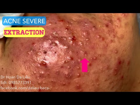 Mụn trứng cá mặt cực nặng|Dermatologist,pimples,blackhead,anti acne,pustule extraction 0985773391