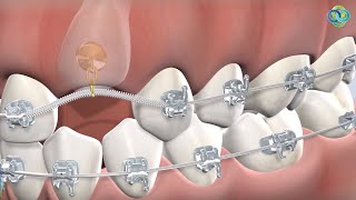 Expose and Bond at Oral Surgery Hawaii in Honolulu, HI
