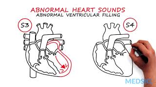 Abnormal Heartsounds and Murmurs: Which heart sounds should worry you