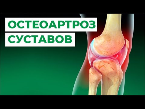 Остеоартроз суставов: причины, диагностика, лечение. Отличие остеоартроза и остеоартрита.