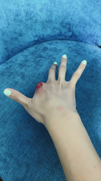 My finger is cut off 🥹😳