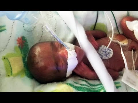 Video: World's Smallest Surviving Baby Finally Goes Home From San Diego Hospital: 'She's A Miracle