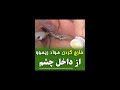 خارج کردن مواد ریمو از داخل چشم خارج کردن مواد ریمو از داخل چشم