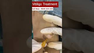 Vitiligo Treatment At Skinaa Clinic 