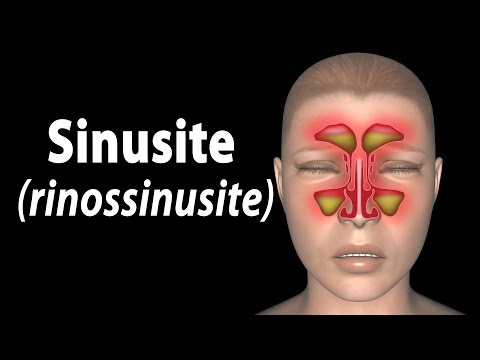 Sinusite, Animação. Alila Medical Media Português