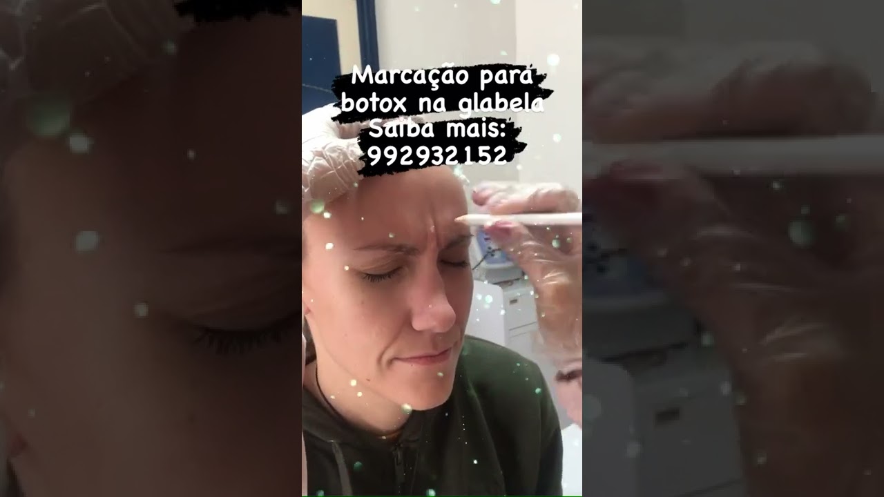 Toxina Botulínica na Glabela