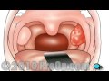 Tonsillectomy Surgery PreOp® Patient Education Feature