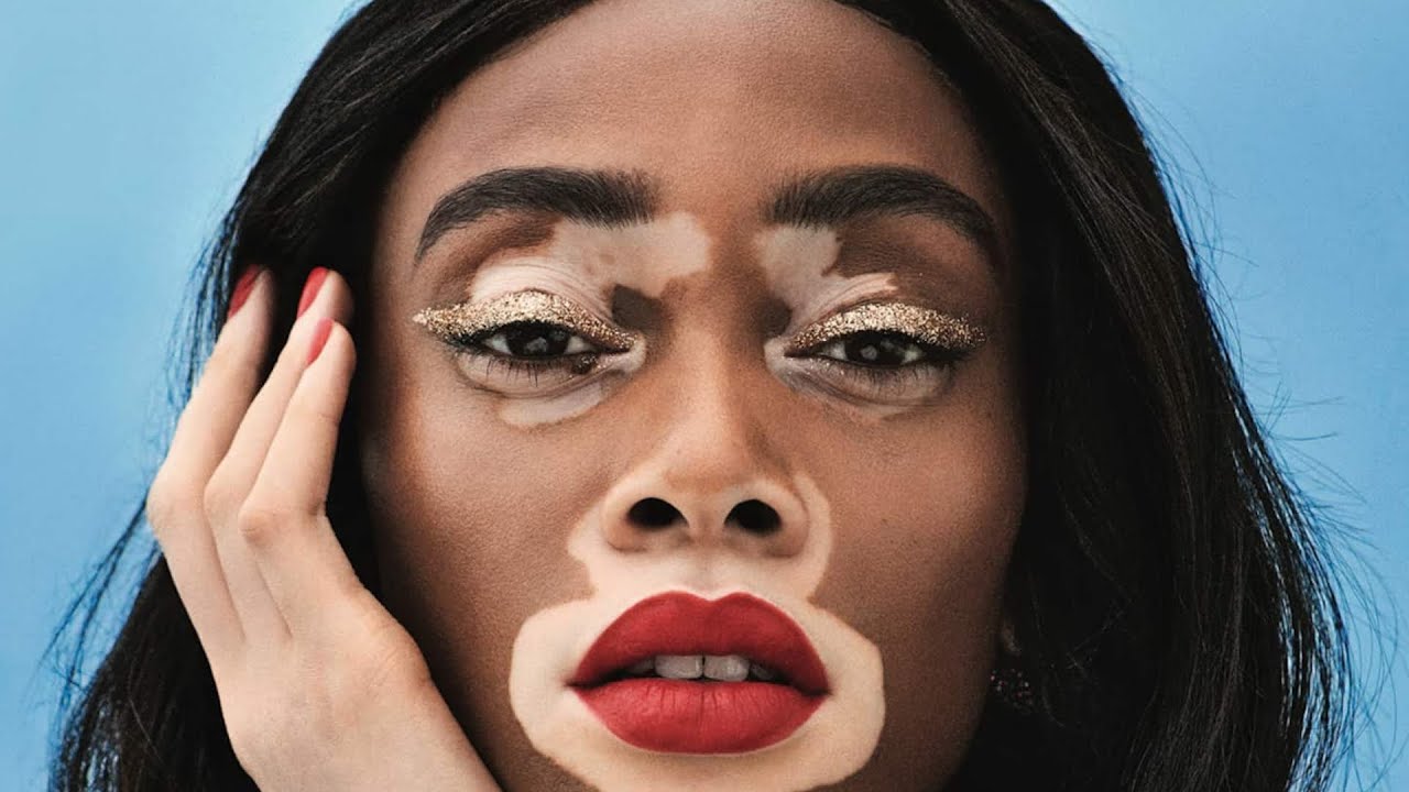 "You can do anything": Model Winnie Harlow shares her best advice