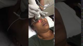 Genesis V Laser Treatment for fine lines, wrinkles, and bags under eyes