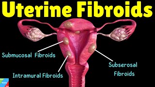 Uterine Fibroids: Types, Symptoms, Causes, Diagnosis, Treatment and Complications screenshot 2