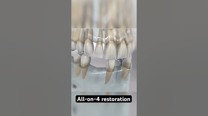 Un'arcata dentale completa con soli quattro impianti! (Animazione 3D)