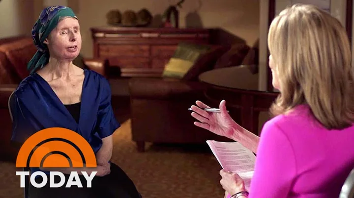 Chimp Attack Survivor Charla Nash Opens Up About F...