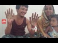 Tree Man of Bangladesh Cured After Undergoing 16 Surgeries | YOYO TV English