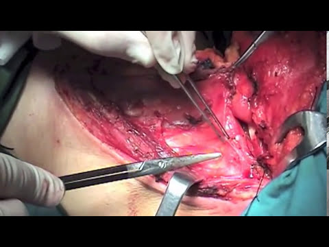 Functional Neck Dissection - YouTube