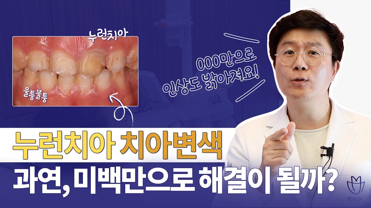 치아미백으로 누런 치아 해결 가능할까?| 인상까지 밝아지는 미니쉬