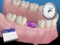 Todo sobre los implantes dentales