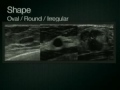 Breast Ultrasound Lesion Assessment BIRADS Ultrasound