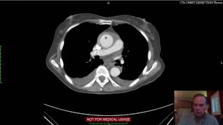 Aortic Mural Hematoma CT