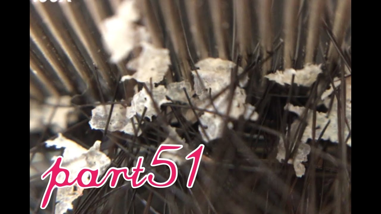 フケ Part51 Dandruff Youtube