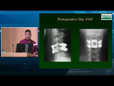 Cervical Facet Fractures and Dislocations