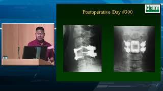 Cervical Facet Fractures and Dislocations