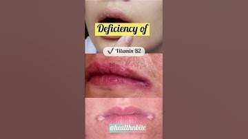 Thumbnail of Vitamin deficiency is the most common cause of cheilitis. #healthnbite #shorts #shortvideo