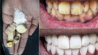 The best teeth whitening recipe / How to whiten teeth at home in just 3 minutes,