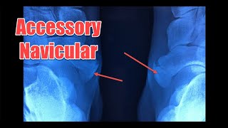 Accessory Navicular medial ankle pain with xray results - a painful lump on the inside of the foot
