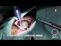 La chirurgie de la cataracte par le dr laurent bouhanna
