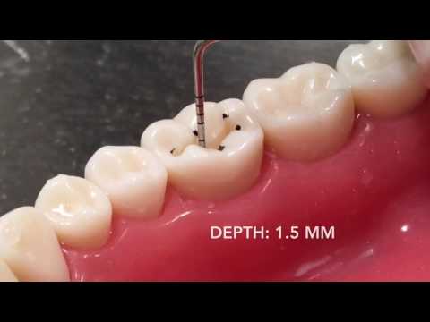 Class I Amalgam Cavity Preparation & Restoration