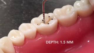 Cl I Amalgam Cavity Preparation & Restoration