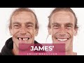 James dental implants smile makeover journey at dental boutique