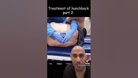 Chiropractic adjustment of severe hunchback! #chiropractor #hunchback #viral #fyp #parati #trending