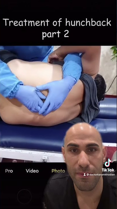 Chiropractic adjustment of severe hunchback! #chiropractor #hunchback #viral #fyp #parati #trending
