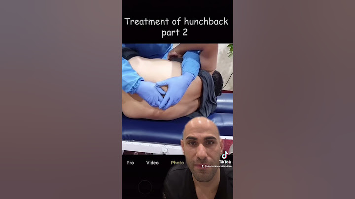 Chiropractic adjustment of severe hunchback! #chiropractor #hunchback #viral #fyp #parati #trending