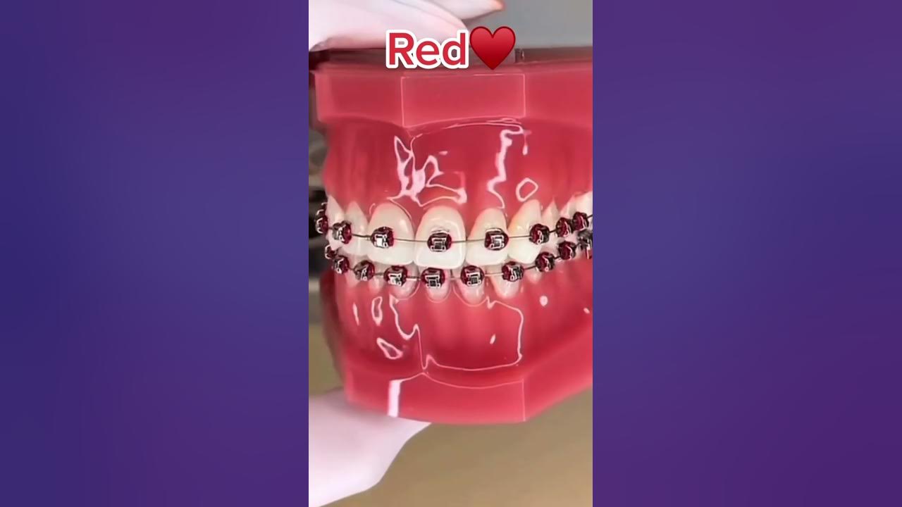best-braces-colors-to-make-your-teeth-look-more-white