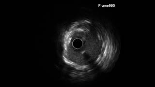 Cine 7: “IVUS Pre Run in the LCx with Opticross™ Catheter”