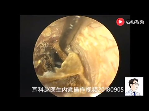 Ear endoscopy for external auditory canal fungus, 耳内镜清理外耳道真菌，12分钟