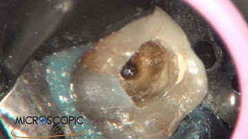 Retrieval of broken endodontic instrument