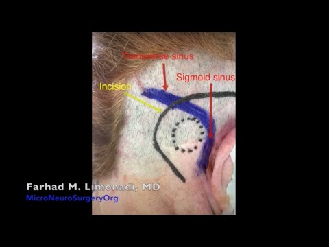 Image Microvascular Decompression Trigeminal Neuralgia