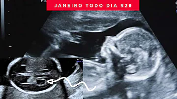 O que é cisto de plexo coróide?
