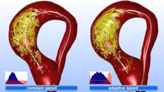VAAS - Adaptive Animations of Vortex Flow Extracted from Cardiac 4D PC-MRI Data