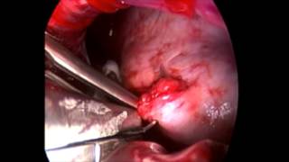 VATS for Stabbing Injuries