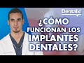 Cómo funcionan los implantes dentales – Dentalk! ©