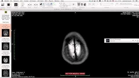Support for low and high resolution monitors in OsiriX